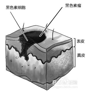 黑痣的形成